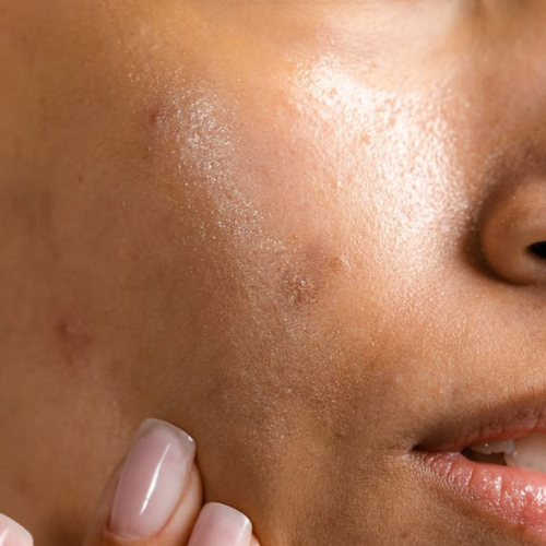 Dry Skin