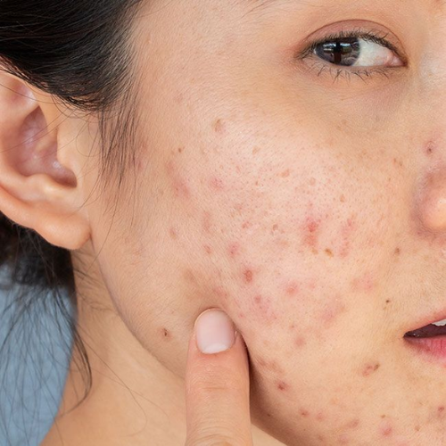 Acne & Darkspot